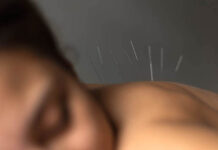 acupuncture Vietnam