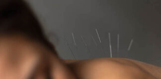acupuncture Vietnam